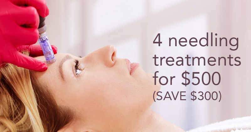 4 skin needling treatments for $500